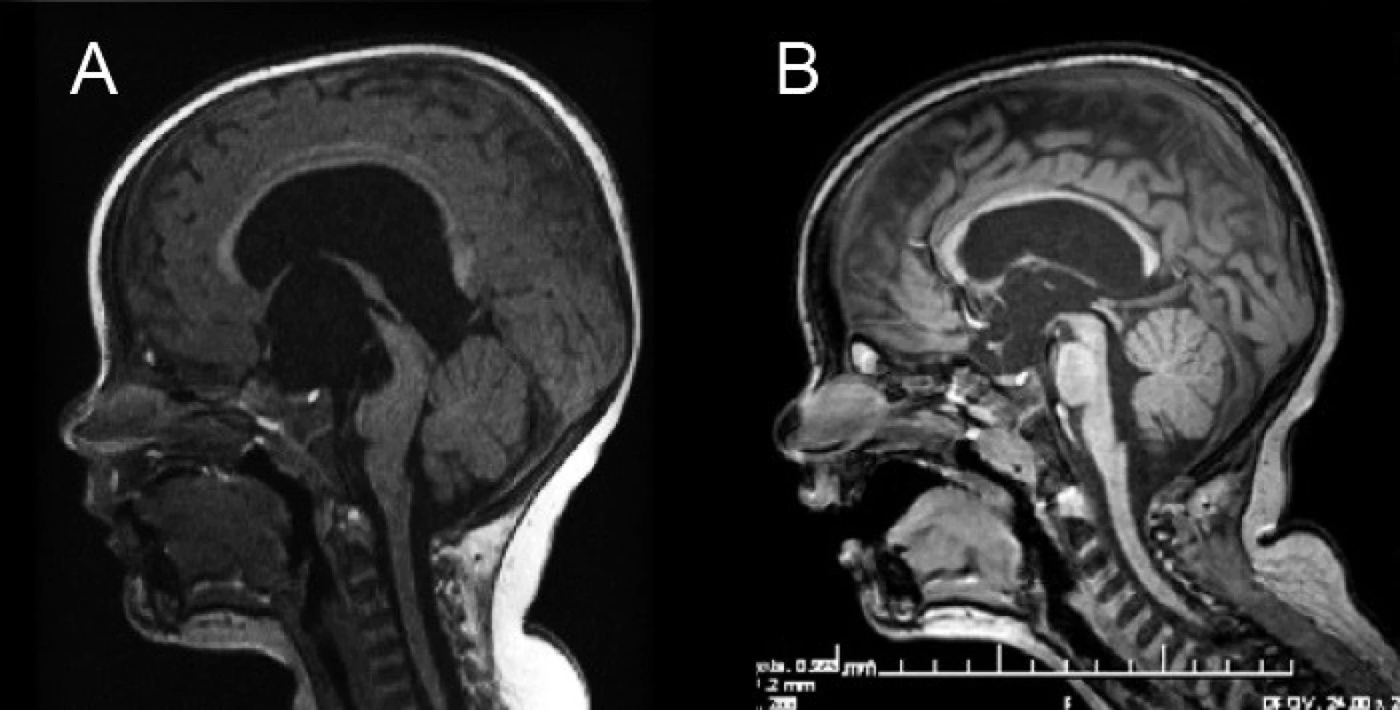 Magnetická rezonancia pacienta s hydrocefalom riešeným neuroendoskopicky – ETV. A – predoperačné MRI mozgu, B – kontrolné MRI 18 mesiacov po ETV.
Fig. 2. Magnetic resonance of a patient with hydrocephalus cured by neuroendoscopy – ETV. A – Preoperative MRI of the brain, B – control MRI 18 months after ETV.