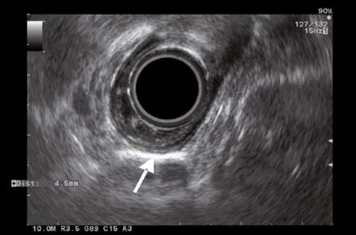 EUS obraz lézie s desmoplastickou reakciou.
Fig. 2. EUS imaging of the lesion with desmoplastic reaction.