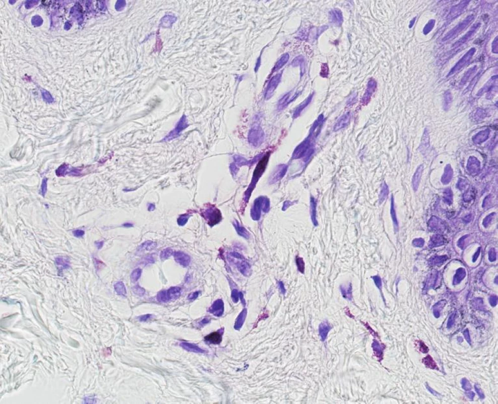 Teleangiectasia macularis eruptiva perstans. V barvení kresylvioletí je patrné hraniční zmnožení vřetenitých
žírných buněk. Odlišení od normálního stavu vyžaduje často korelaci s klinickým obrazem nebo i kontrolní excizi
z nepostižené kůže (obj. 60x, imerze).