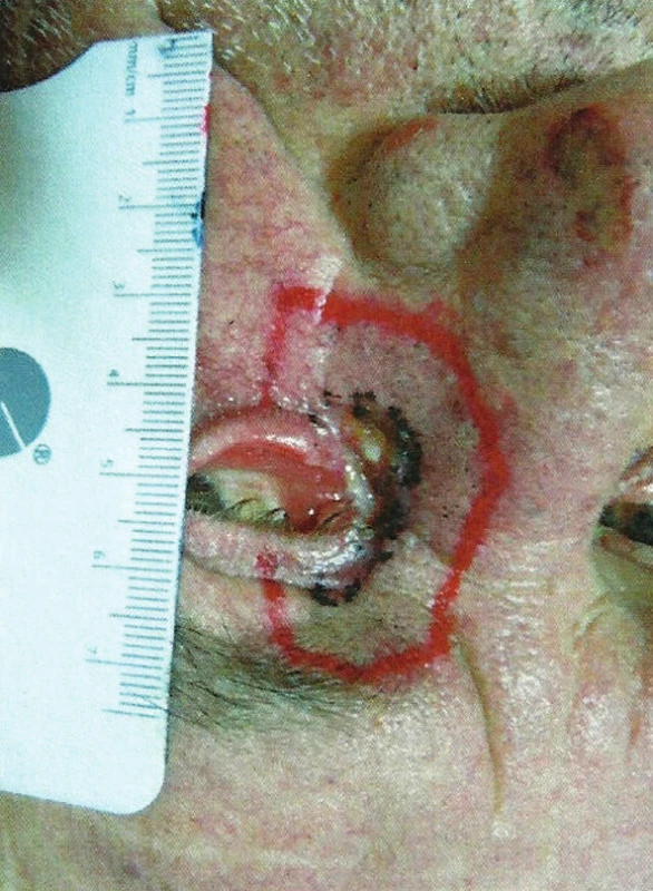 Zakreslenie recidivujúceho ložiska (čierna farba) s lemom 5–10 mm (červená farba) pred vytvorením orfitovej masky