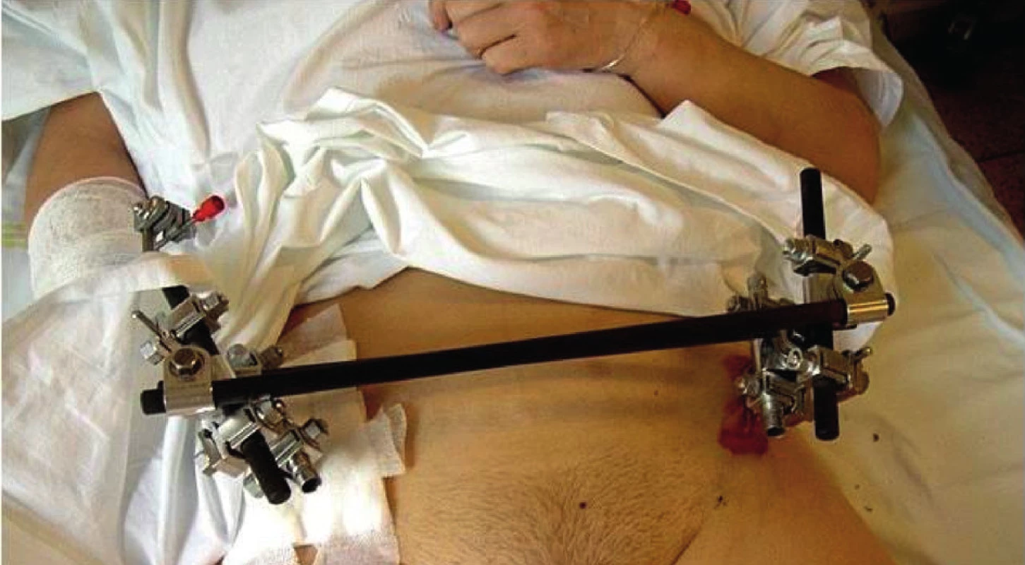 Zevní fixace zlomeniny pánve
Fig. 2: External fixation of pelvic fractures