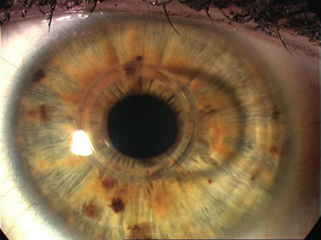 Rohovka s implantovaným MyoRingem