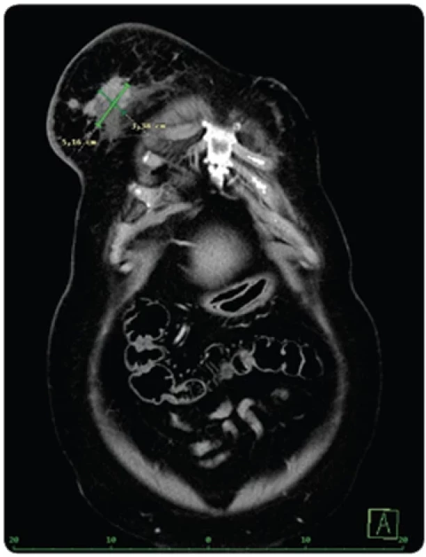 Snímek CT z 9/23. Závěr: další tendence ke zvětšení nodulací v pravém prsu a v nadklíčcích bilaterálně. Dle kritérií Response Evaluation Criteria in Solid Tumors obraz odpovídá progresi onemocnění. 