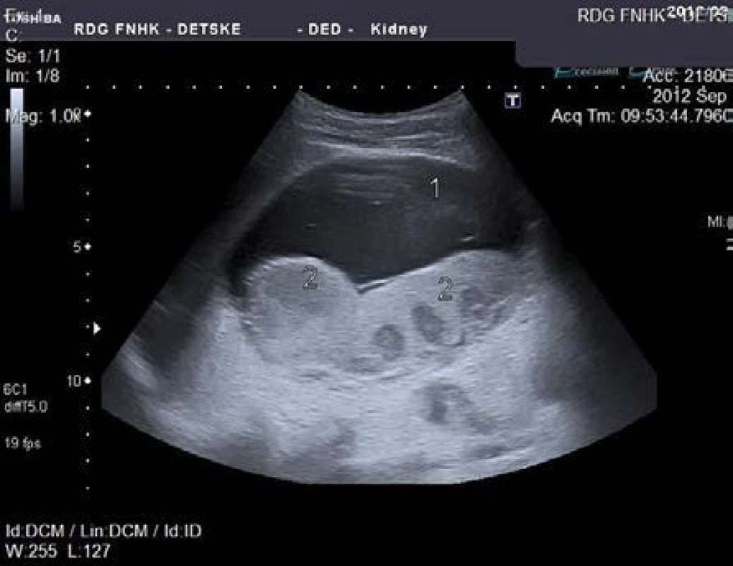 Sonografie pravé ledviny: 1) recidiva tekutinové kolekce (12x7 cm), 2) tvarově defigurovaný parenchym ledviny
Fig. 2. Ultrasound of right kidney: 1) recurrent fluid collection (12x7 cm), 2) distorted renal parenchyma