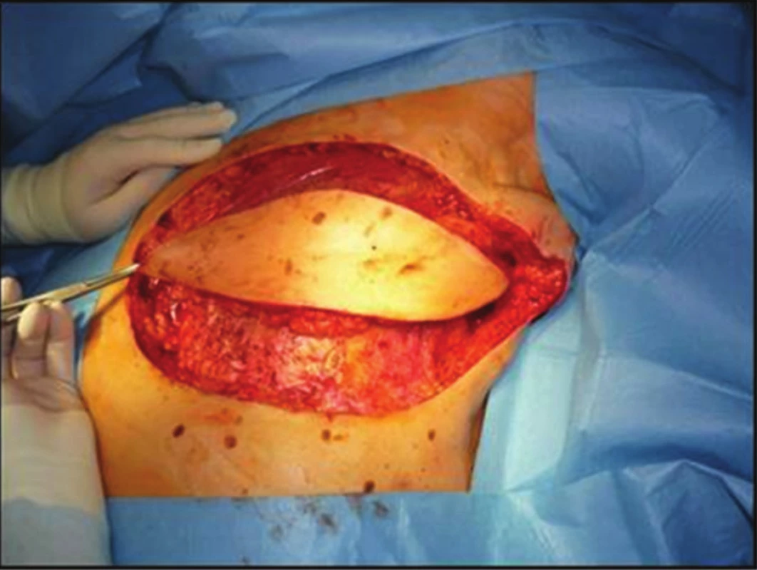 Radikální reexcize jizvy po mastektomii s krytím defektu lalokem m. latissimus dorsi
Fig. 3: Radical re-excision of mastectomy scar covered with musc. latissimus dorsi flap