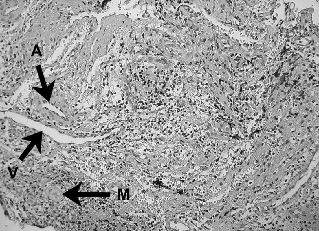Prítomnosť fagocytujúceho makrofágu v periapikálnom granulóme (M) Ďalej vidno arteriolu (A) a venulu (V) – autor Ján Kováč.
Fig. 9. The presence of a phagocyting macrophage (M) in periapical granuloma. An arteriole (A) and a venule (V) can also be seen – Author Ján Kováč.