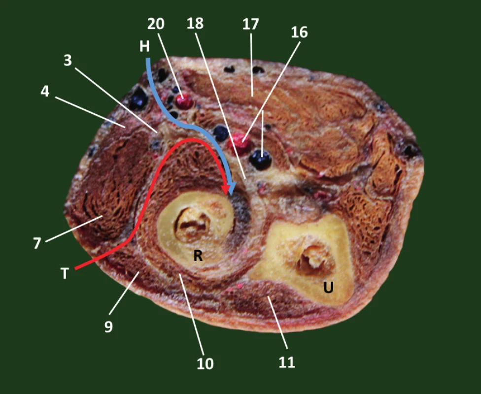 Průřez proximálním předloktím (pravá strana): a – schéma, b – preparát: 1 – n. cutaneus antebrachii lat., 2 – v. cephalica, 3 – r. superficialis n. radialis, 4 – m. brachioradialis, 5 – m. extensor carpi radialis longus, 6 – n. cutaneus antebarachii post., 7 – m. extensor carpi radialis brevis, 8 – r. profundus n. radialis, 9 – m. extensor digitorum, 10 – m. supinator, 11 – m. extensor carpi ulnaris, 12 – m. flexor carpi ulnaris, 13 – fascia antebrachii, 14 – n. ulnaris, 15 – a. ulnaris, 16 – a. et v. interossea communis, 17 – společná hlava flexorů předloktí, 18 – šlacha m. biceps brachii, 19 – n. medianus, 20 – a. et v. radialis, H – Henryho přístup, T – Thompsonův přístup, R – radius, U – ulna. <i>(Převzato z Bartoníček J. Operační přístupy u zlomenin hlavičky a diafýzy rádia. Acta Chir Orthop Traumatol Čech 1988;55:497−516.)</i>
Fig. 1: Proximal forearm cross-section (right site): a – drawing, b – anatomic specimen: 1 – lateral cutaneous nerve of forearm, 2 – cephalic vein, 3 – superficial branch of radial nerve, 
4 – brachioradialis, 5 – extensor carpi radialis longus, 6 – posterior cutaneous nerve of forearm, 
7 – extensor carpi radialis brevis, 8 – deep branch of the radial nerve, 9 – extensor digitorum, 
10 – supinator, 11 – extensor carpi ulnaris, 12 – flexor carpi ulnaris, 13 – antebrachial fascia, 
14 – ulnar nerve, 15 – ulnar artery, 16 – common interosseous artery and vein, 17 – common head of forearm flexors, 18 – biceps brachii tendon, 19 – median nerve, 20 – radial artery and vein, 
H – Henry approach, T – Thompson approach, R – radius, U – ulna. <i>(Reprinted from Bartoníček J. [Surgical approaches in fractures of the head and shaft of radius].(Acta Chir Orthop Traumatol Čech 1988;55:497−516.)</i>