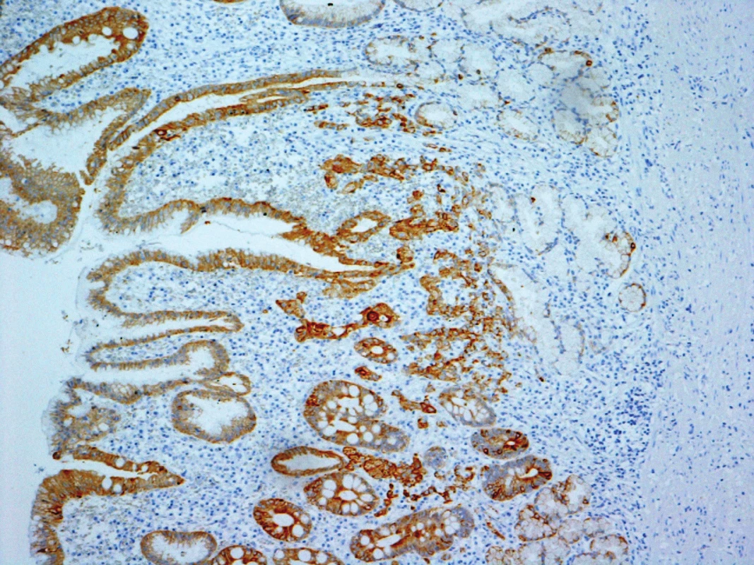 Infiltrující karcinomové struktury ve sliznici žaludeční - v imunohistochemickém průkazu cytokeratinů Originální zvětšení 100x
Fig. 3: Infiltrating carcinoma structures in gastric mucosa – immunohistochemical cytokeratins evidence Original magnification 100x