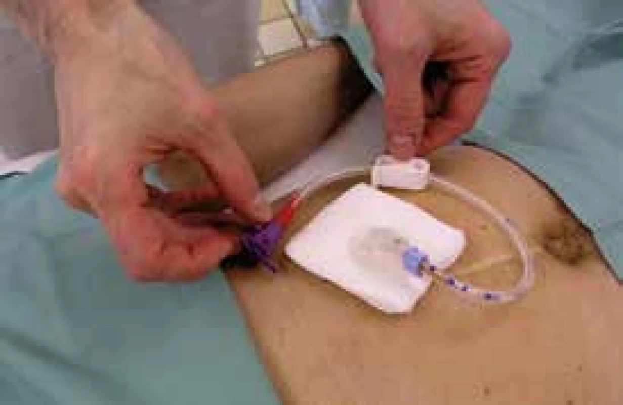 Perkutánní endoskopická gastrostomie – externí pohled