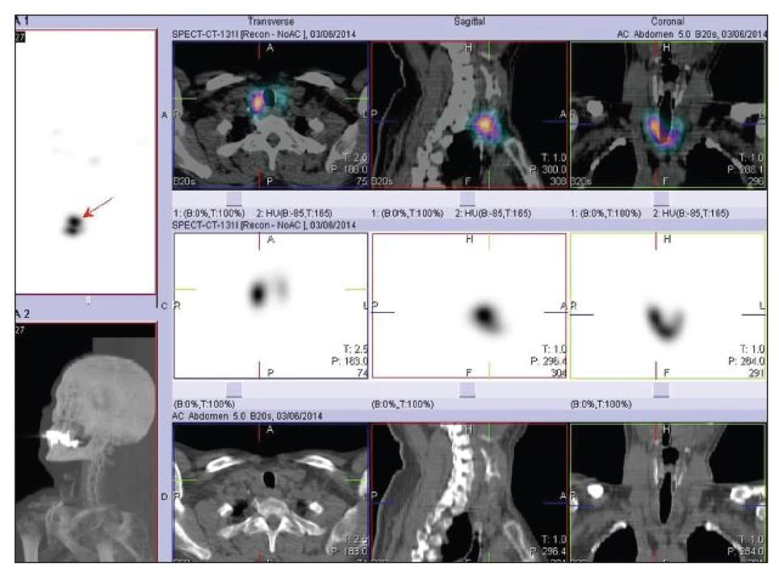 SPECT/low dose CT krku po terapii <b>7,4 GBq <sup>131</sup>I</b> s výrazně kontrastní depozicí <b>radiojódu</b> v lůžku štítné žlázy vpravo paratracheálně odpovídající reziduu štítné žlázy.