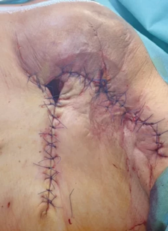 Status post repeated debridements and treatment with a vacuum assisted closure (VAC) system.