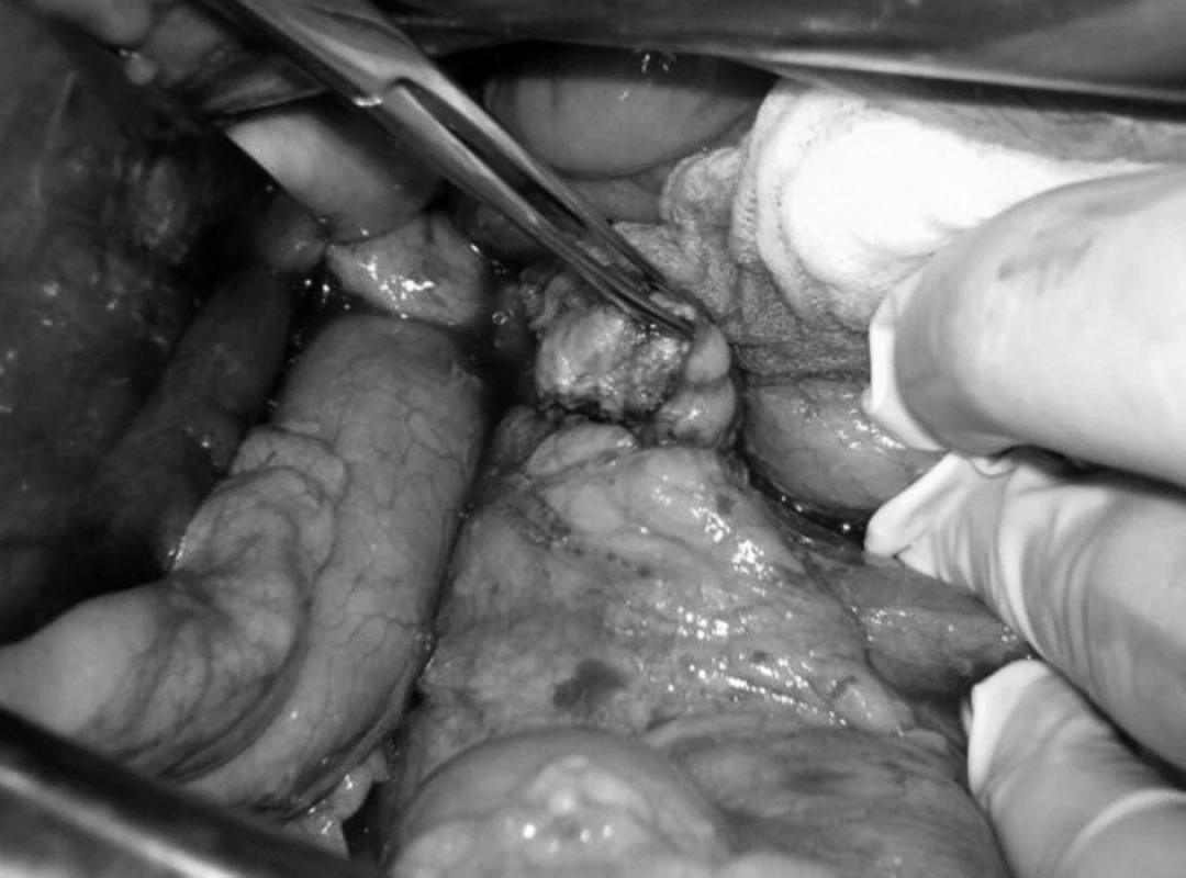 Lokalizácia nádoru počas operácie.
Fig. 1. Localization of tumor during surgery.
