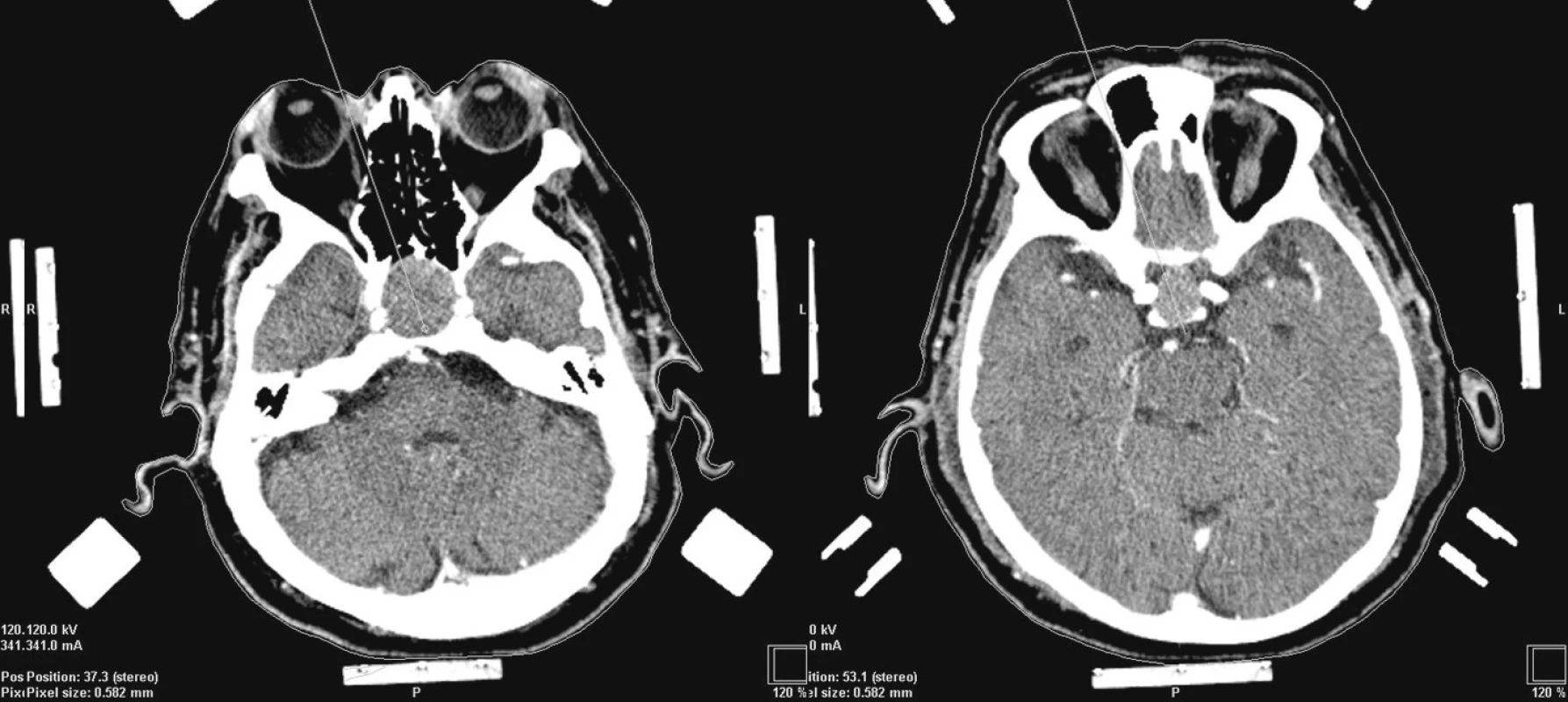 Plánování trajektorie k radiofrekvenční termoablaci adenomu hypofýzy
Fig. 3. Trajectory planning in radiofrequency thermoablation of a hypophyseal adenoma
