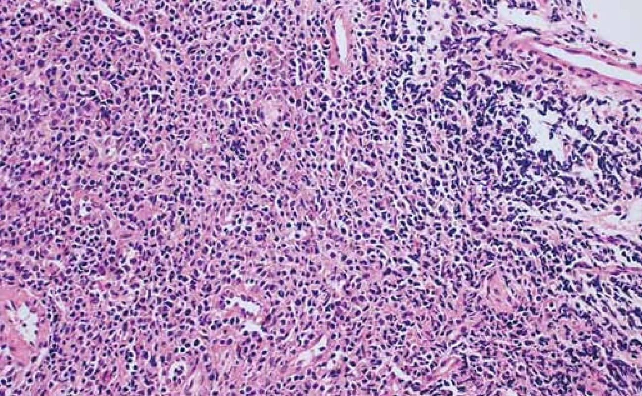 Histologické vyšetření bioptického vzorku odebraného z místa stenózy. Barvení hematoxylin-eozin, zvětšeno 400×.
