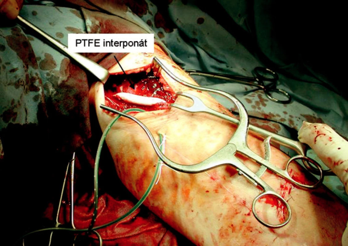 PTFE protézou nahrazená část perforované basilické žíly
Fig. 9. A PTFE prosthesis replacing a section of the perforated basilic vein