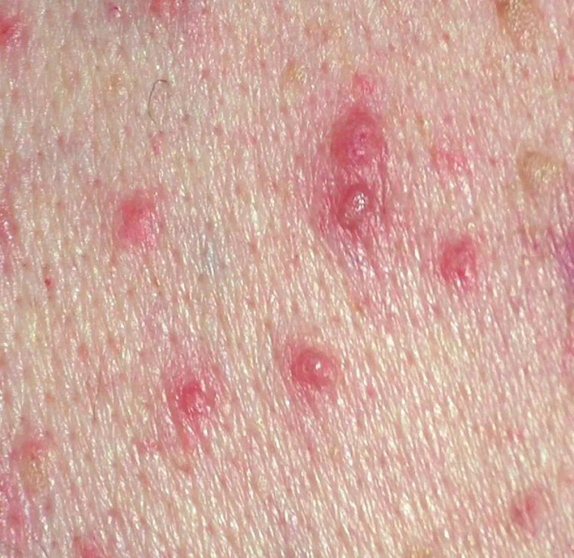 Morbus Grover – detail papuly, papulovezikuly (vpravo a nahoře seboroické veruky).
