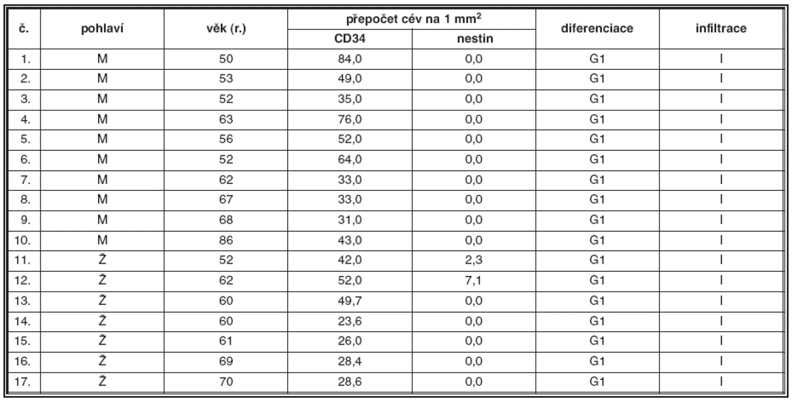 Plazmocytární myelom G1, intersticiální infiltrace