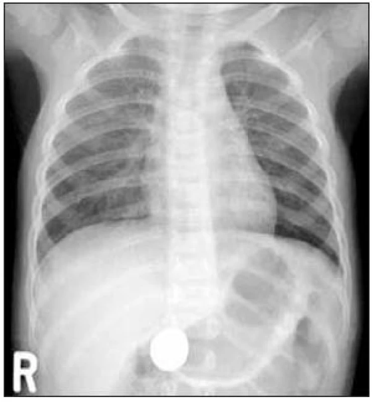 Mince v antru žaludku.
Fig. 4. Coin in the gastric antrum.