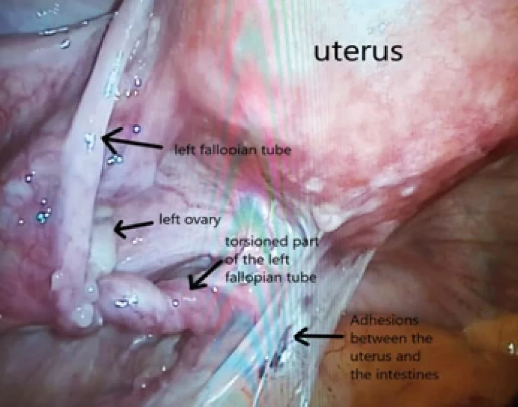 Isolated left fallopian tube torsion in the postmenopausal period.