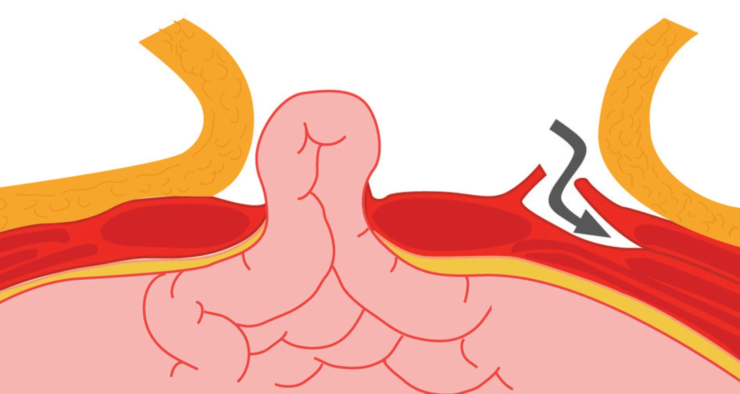Schéma protnutí fascie zevního šikmého svalu v místě, kde přechází ve fascii přímých břišních svalů
Fig. 1: Diagram of the incision of the obliquus externus muscle fascia at the site of its transition into fascia of the rectus abdominis muscles