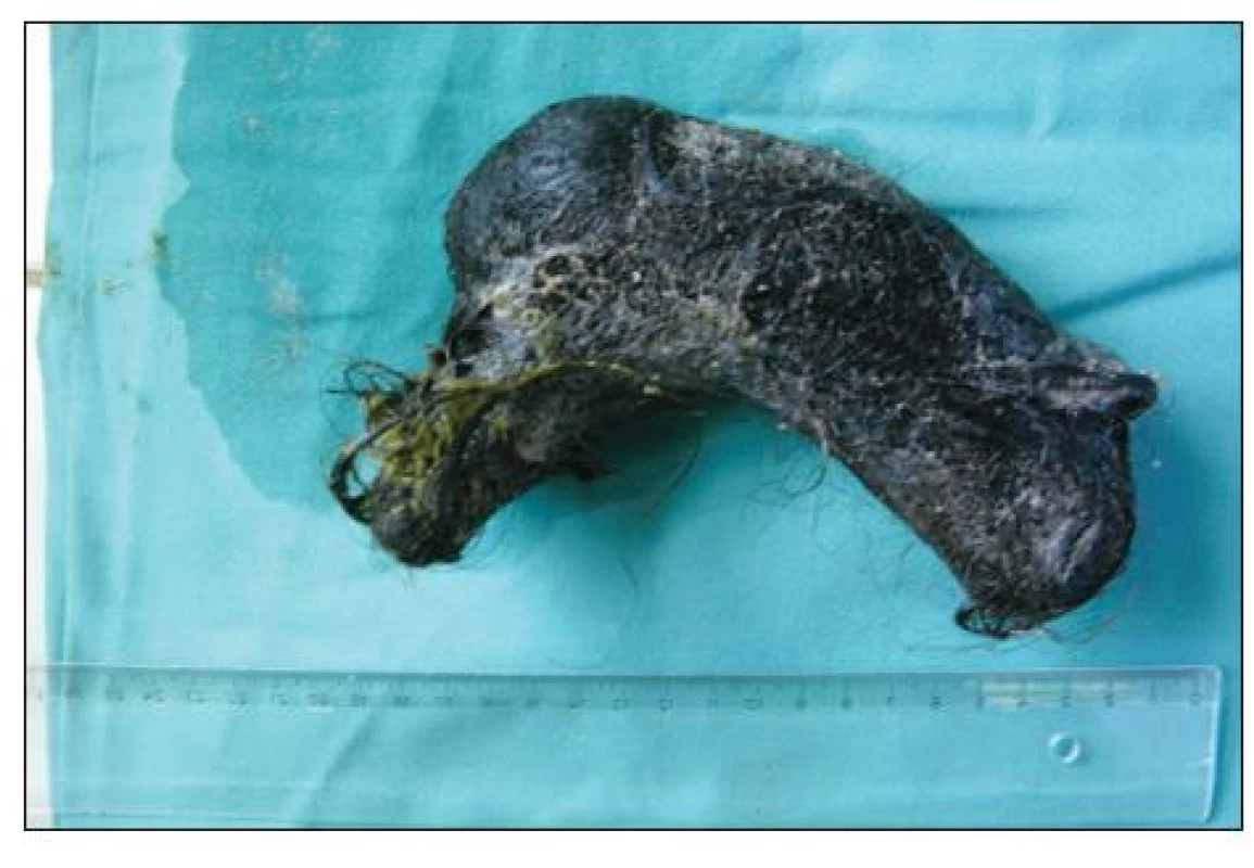 Trichobezoár, extrahovaný ze žaludku
Fig. 1. Trichobezoar, extracted from the girl‘s stomach