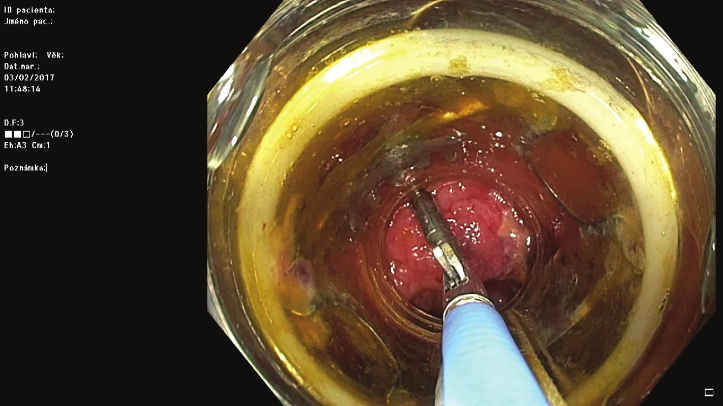 a) LRN (0-IIa dle Pařížské klasifikace) base céka; b) EMR okrajových částí LRN − submukózní aplikace fyziologického roztoku s methylenovou modří; c) EMR okrajových částí LRN - resekce kličkou; d) uchopení zbytku léze pomocí speciálních kleští
Fig. 3: a) LRN (0-IIa according to the Paris classification) of the cecum; b) EMR of marginal parts of the LRN – submucosal injection of saline with methylene blue; c) EMR of marginal parts of the LRN – snare resection; d) grasping of the residual lesion by special forceps (“grasper”)