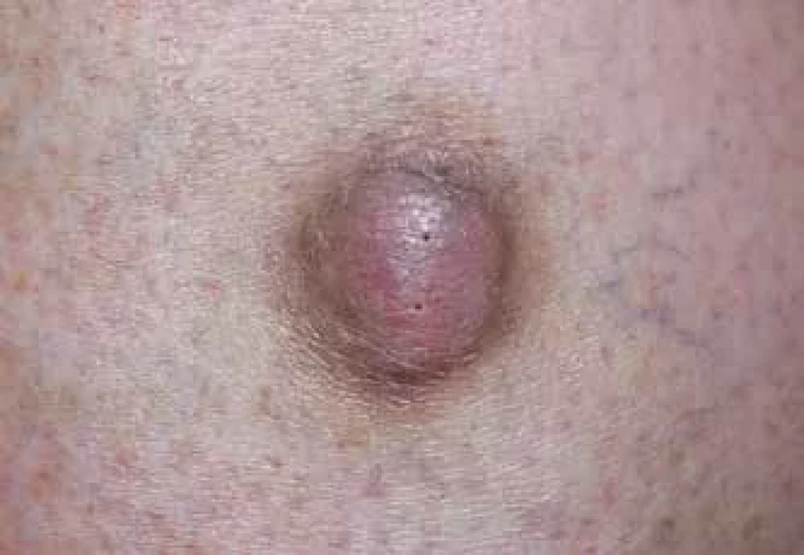 Dermatofibrom.