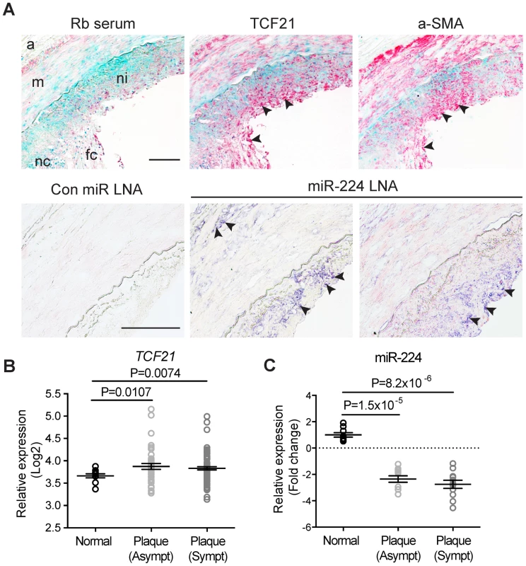 Expression of TCF21 and miR-224 in human atherosclerotic lesions.