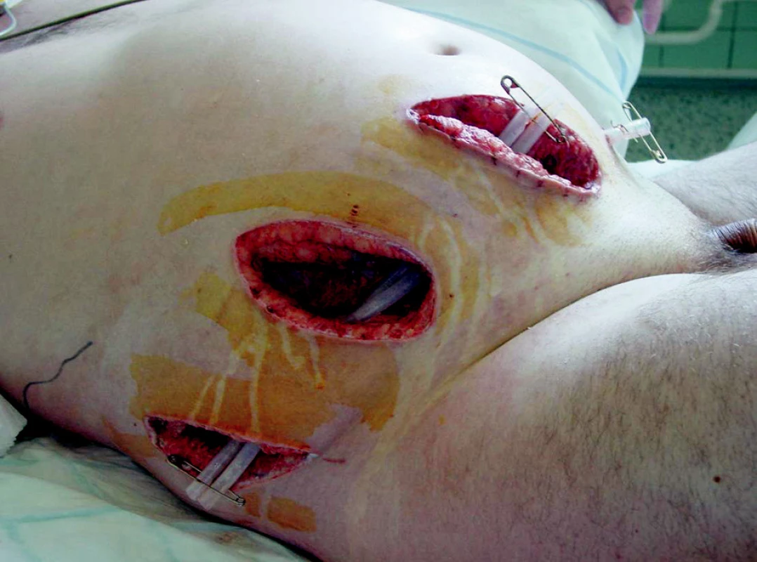 Extenzivní drenáž břišní stěny
Fig. 1. Extensive abdominal wall drainage
