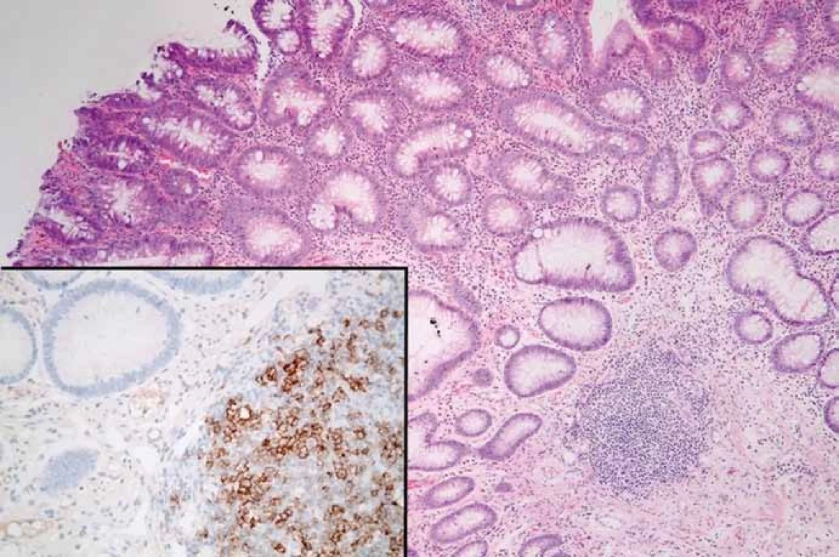Tubulární adenom s low-grade dysplazií, v jehož stromatu je drobný lymfoidní agregát (hematoxylin-eozin, původní zvětšení 100×). Lymfoidní agregát je kolonizován CD23-pozitivními buňkami CLL/SLL (vložený detail, původní zvětšení 400×).
Fig. 4. Tubular adenoma with low-grade dysplasia with a lymphoid tissue in its stroma (hematoxylin-eosin, 100× magnification). The lymphoid tissue is colonized by CD-23 positive CLL/SLL cells (detail, 400× magnifi cation).