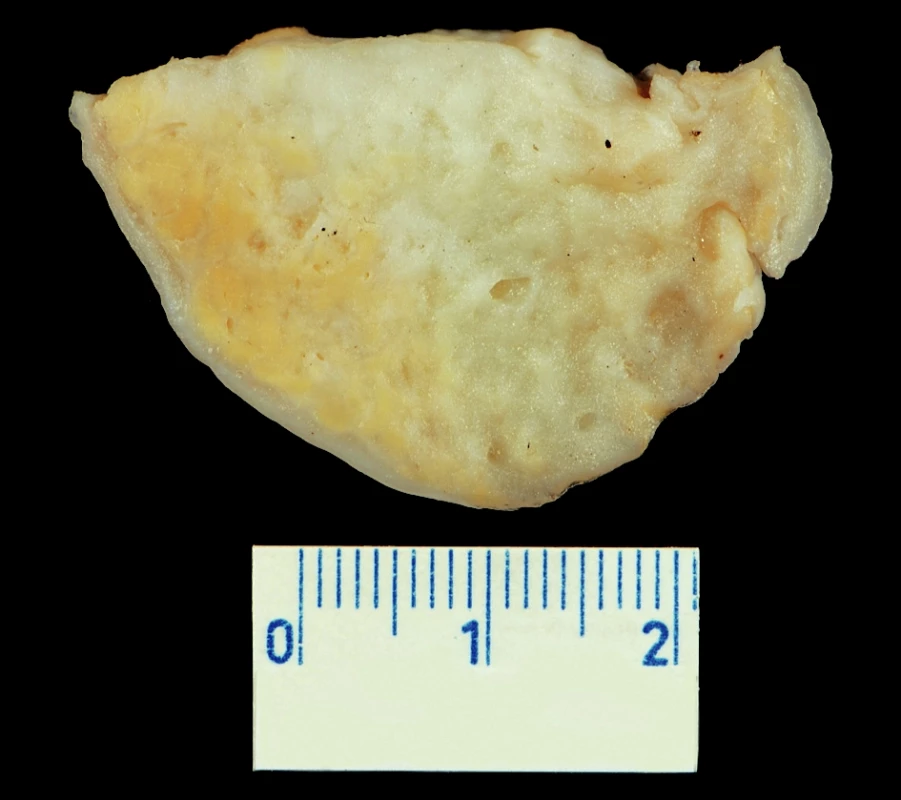Sklerozující stromální tumor: makroskopický vzhled (v centru nádor fibrózně změněný a edematózně prosáklý, v periferních partiích jsou patrna nepravidelná žlutavá ložiska)