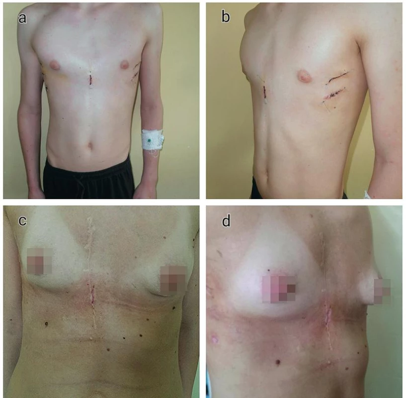 Pooperačný nález u pacientov po MIRPE
a−b) 17ročný pacient
c−d) 27ročná pacientka
Fig. 5. Post-operative appearance following MIRPE
a−b) 17-year-old male
c−d) 27-year-old female