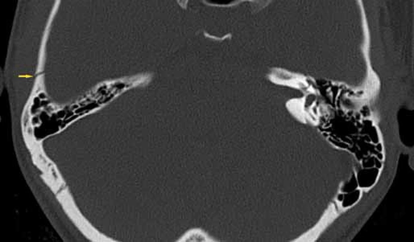 Nepetrózní fraktura – squama, HRCT, axiální rovina.
Fig. 6. Non-petrous bone fracture (squama), HRCT, axial plane.