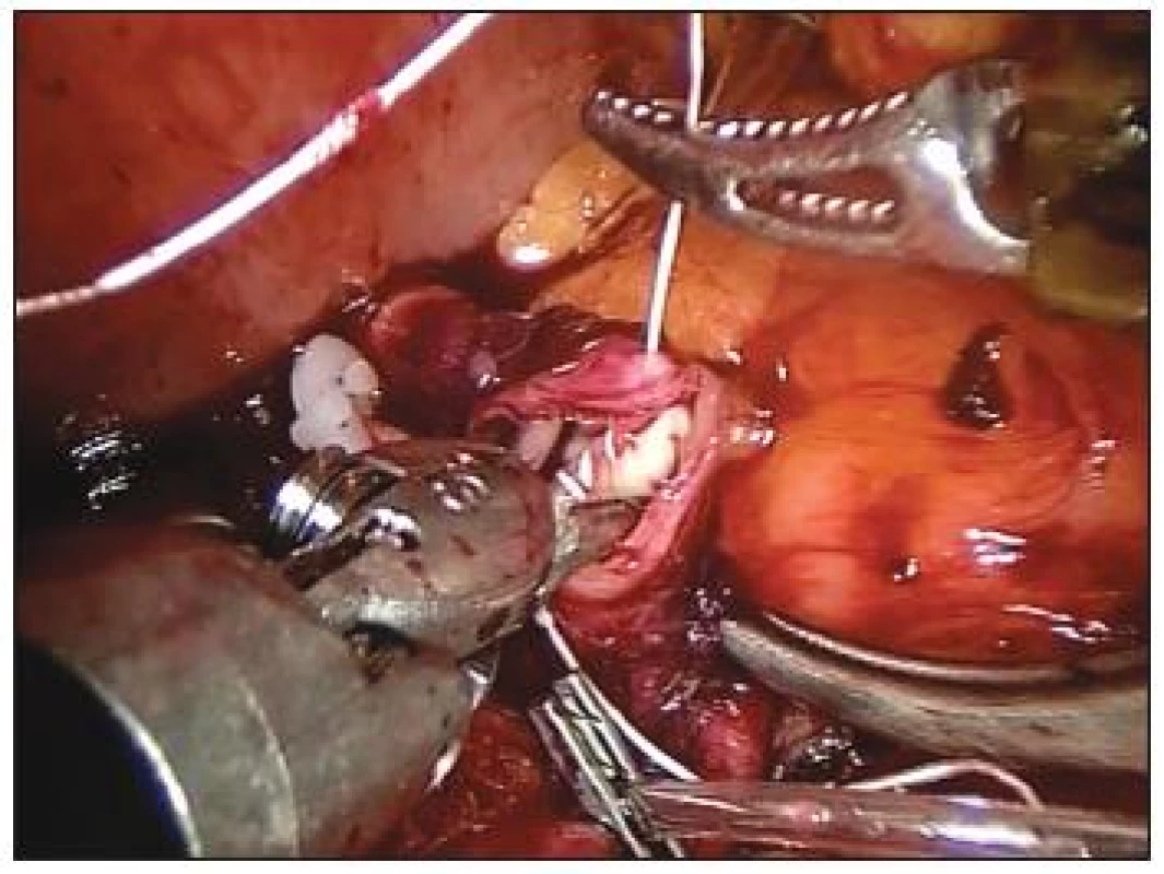 Přímá end to end anastomóza slezinné tepny po exkluzi její výdutě
Fig. 7. Direct, end to end anastomosis of the splenic artery, following exclusion of the aneurysm