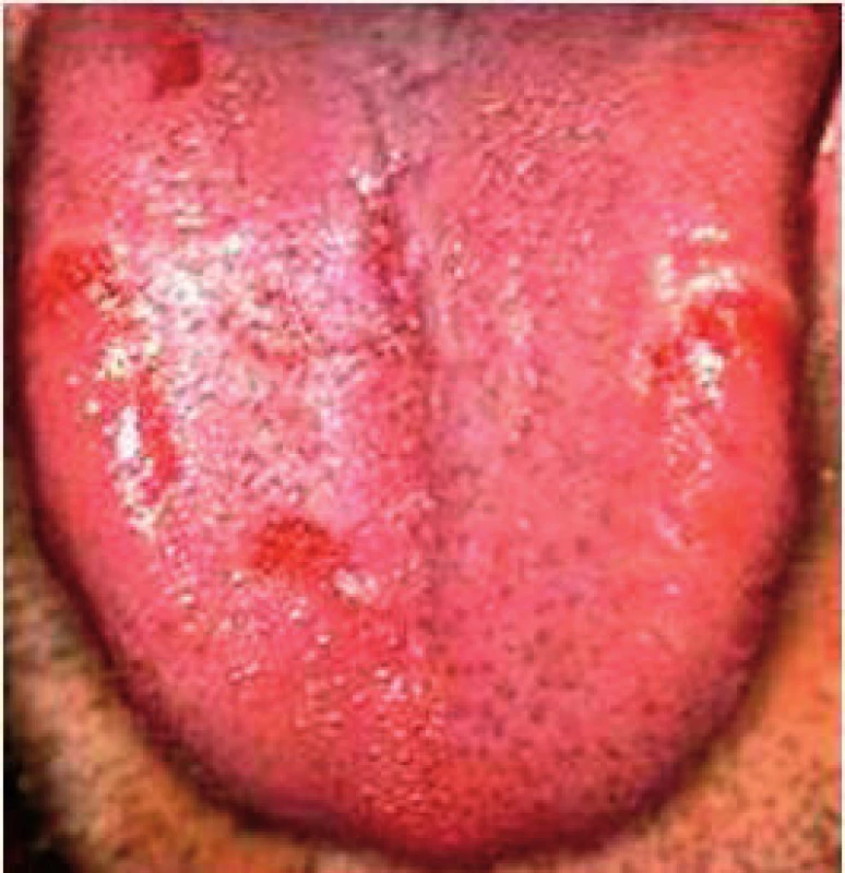 Povlak je normálný, na povrchu jazyka sú čerstvé erozie. Stav je u recidívnej infekcii <i>Helikobakter pylori</i> (Ďurovič)