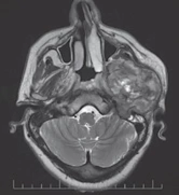Pre-operative MRI – fi rst case.