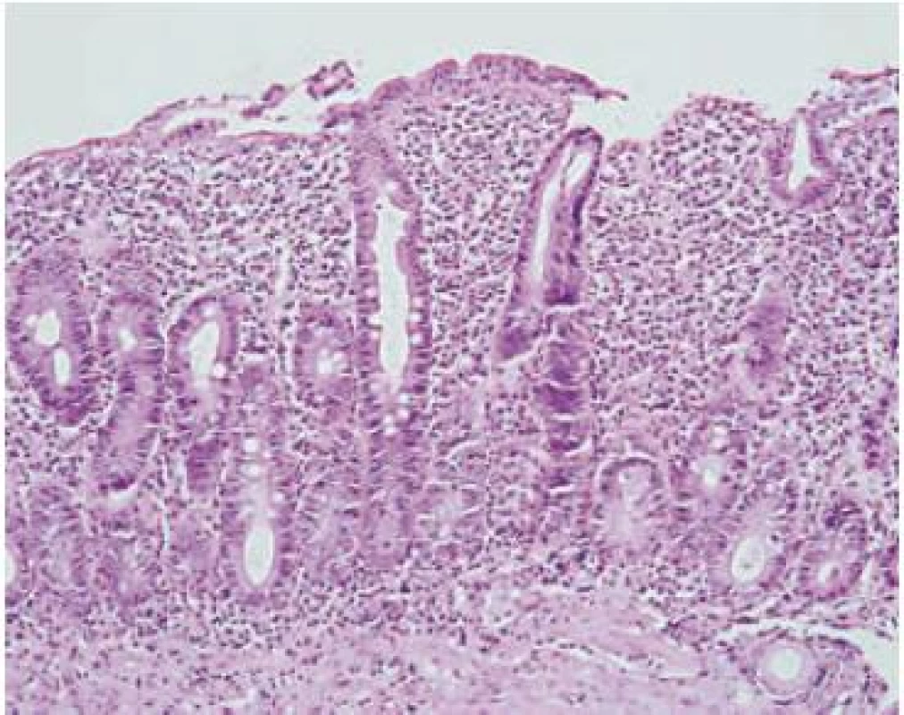 Totálna atrofia klkov (Marsh-Oberhuber 3c), sliznica je v celej výške tvorená hyperplastickými kryptami. Hematoxylín-eozín, x 200.
Fig. 3. Total villous atrophy (Marsh-Oberhuber 3c); the mucous membrane consists of full-height hyperplastic crypt; Hematoxylin-eosin, x 200.