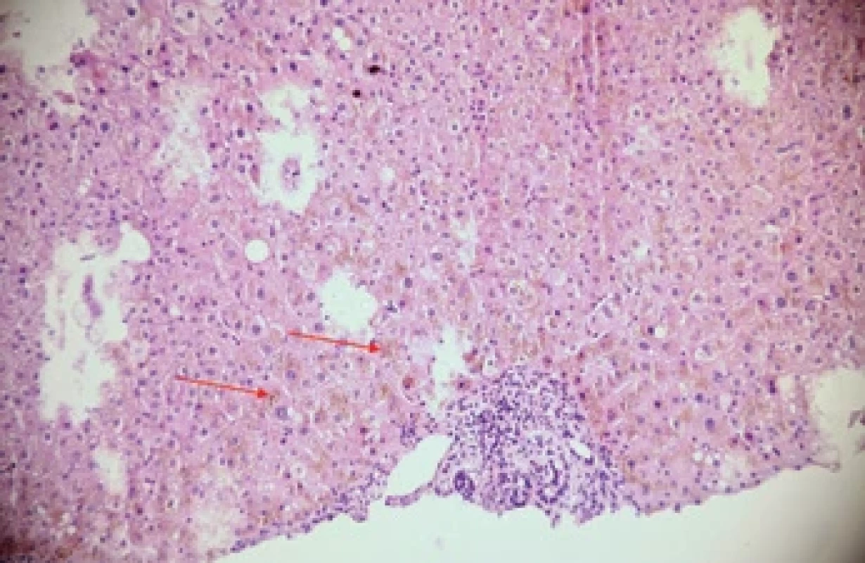 Biopsie jater hemochromatózy ukazující hepatocyty se zlatožlutými granulemi hemosiderinu v cytoplazmě. Zvětšeno 200×, barvení hematoxylin-eosin. Fig. 􀍷. Liver biopsy showing hepatocytes with golden-yellow hemosiderin granules in the cytoplasm. Magnifi ed 200×, hematoxylin-eosin staining.