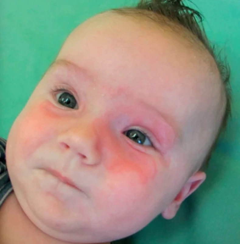 Neonatální lupus erythematodes, chlapec 3 měsíce