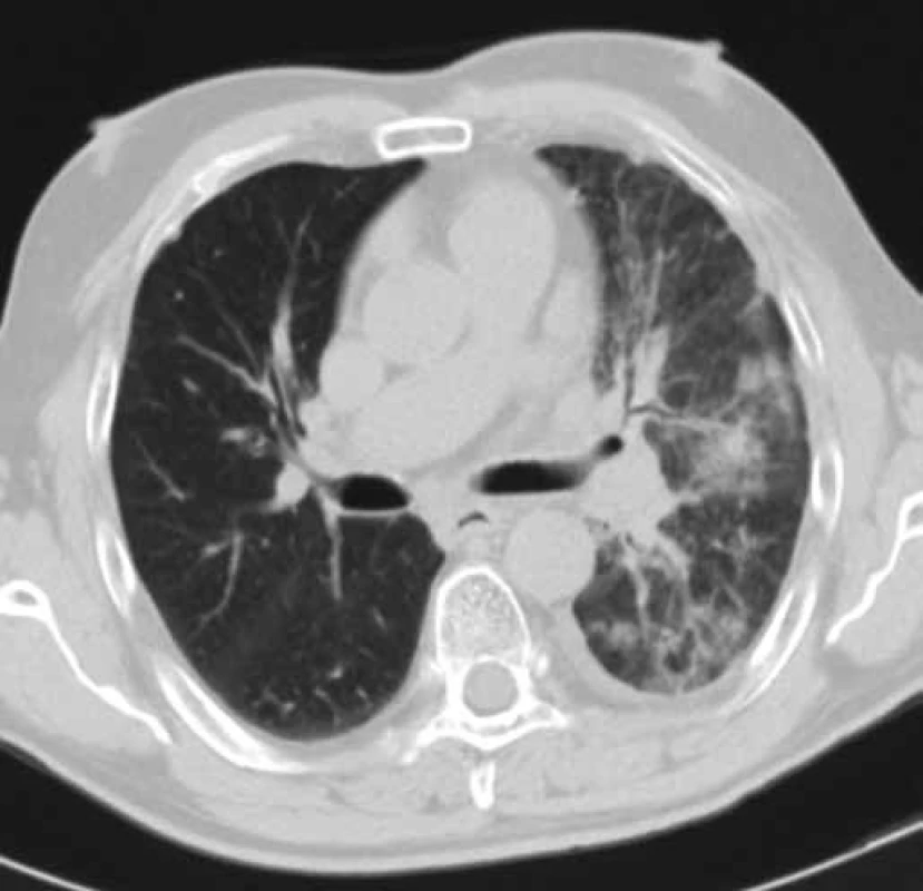 CT hrudníku pacienta č. 2 v době zahájení léčby erlotinibem (leden 2010).
Obrázek znázorňuje tumor dolního laloku levé plíce cirkulárně zužující průsvit dolního lobárního bronchu a související dys-/atelektatické změny dolního laloku levé plíce