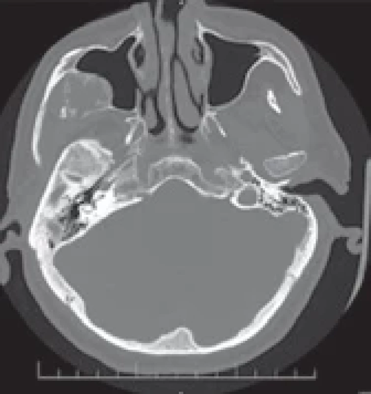 Pre-operative MRI – second case.