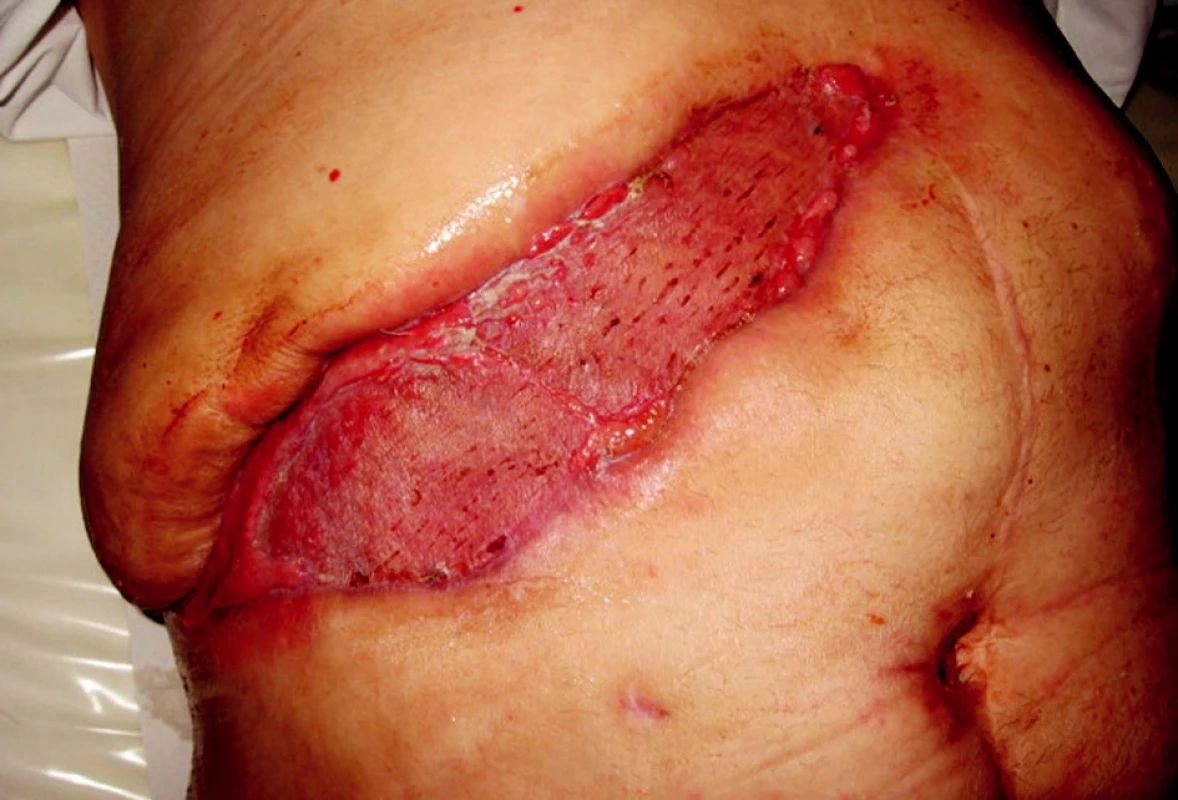 Po krytí dermoepidermálním štěpem
Obr. 4. After dermoepidermal skin graft