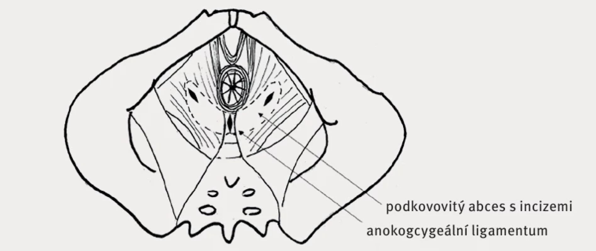 Podkovovitý absces s origem v hlubokém postanálním prostoru šířící se oboustranně  do ischiorektálních prostorů [28].  Horseshoe-shaped abscess originating in the deep postanal space spreading bilaterally into  the ischiorectal spaces [28].