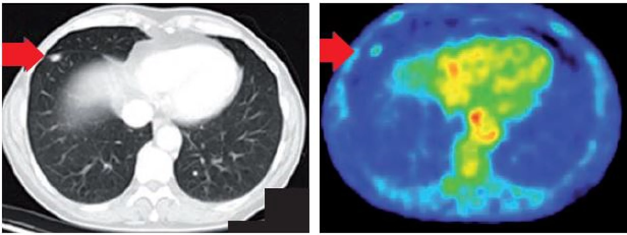 PET/CT ložisko v dolním laloku.