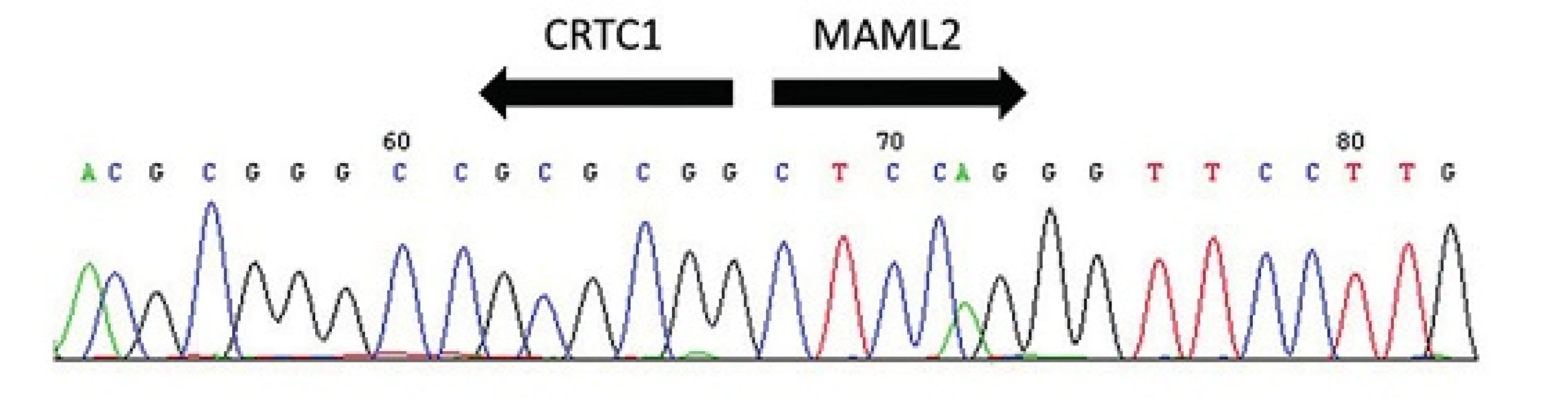 Sekvenogram fúzního transkriptu <i>CRTC1-MAML2</i>. Šipky vyznačují místo fúze.