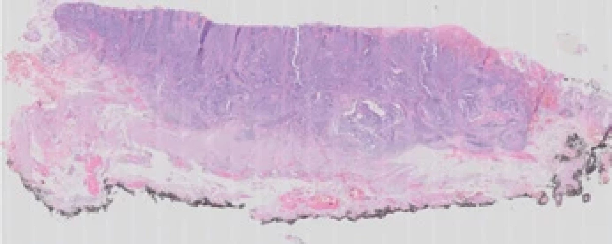 Histologický preparát. Centrálně příznak retrakce svalové vrstvy.