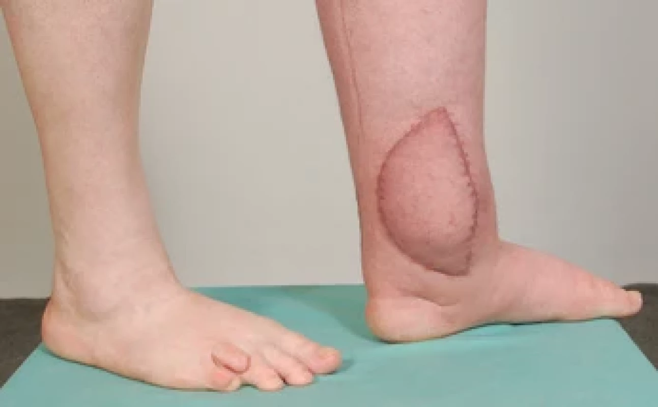 Healed vascularized fl ap with lymph nodes, microanastomoses end-to-side to tibialis posterior vessels.