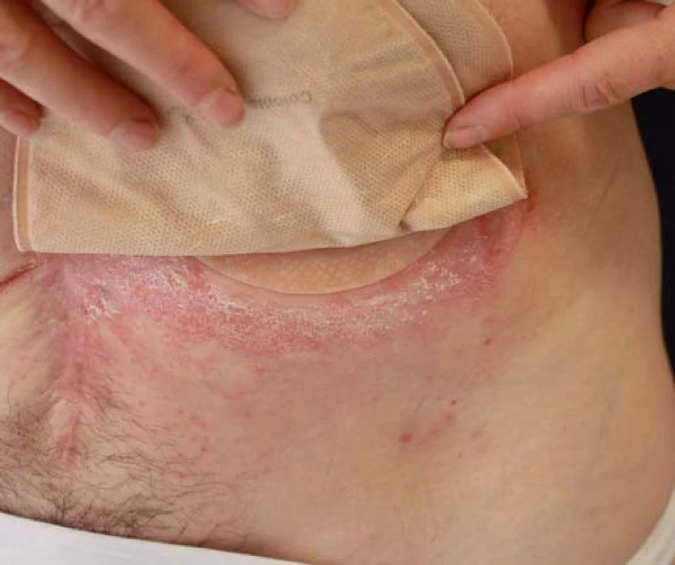 Iritační dermatitida v okolí stomie.
Fig. 6. Peristomal irritant contact dermatitis.