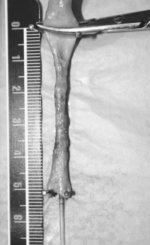Kontrakce žíly v důsledku aplikace laserové energie
Fig. 1. Shrinkage of the vein due to application of laser energy