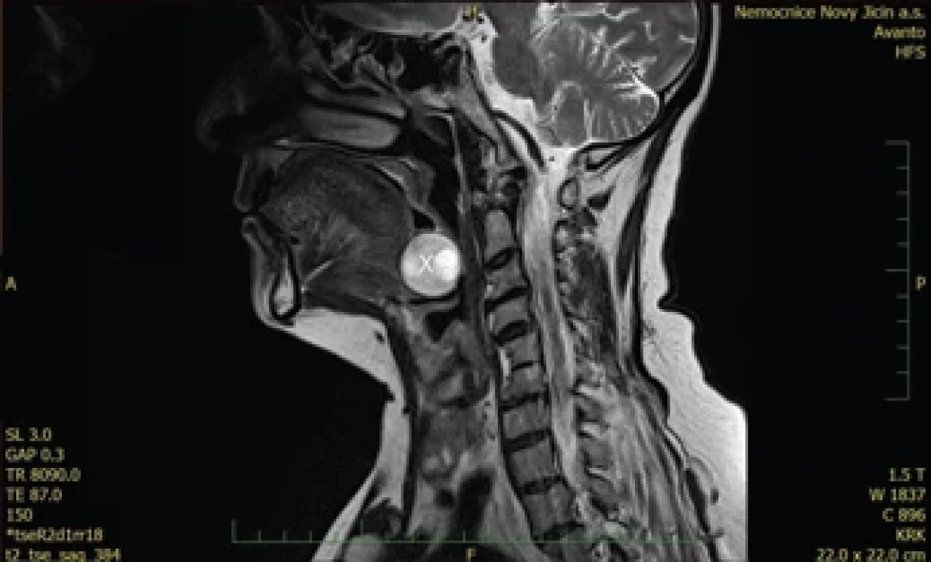 MR vyšetření (T2), sagitální řez, tumor označen křížkem.MRI examination (T2), sagittal section, tumor marked with a cross.